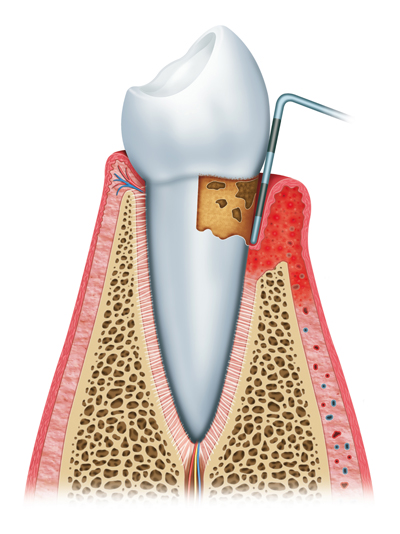 Periodontitis Example