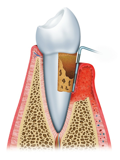 Advanced Periodontitis example