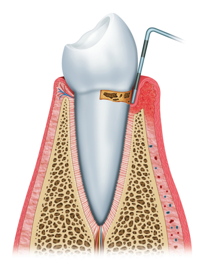 Gingivitis Example