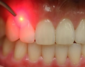 The Advantages of Laser Dentistry