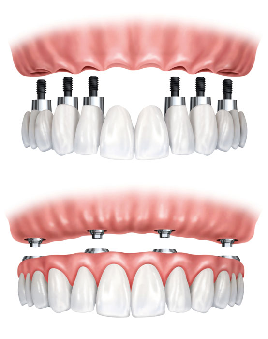 Implant Supported Dentures with Dr. Susan Hong